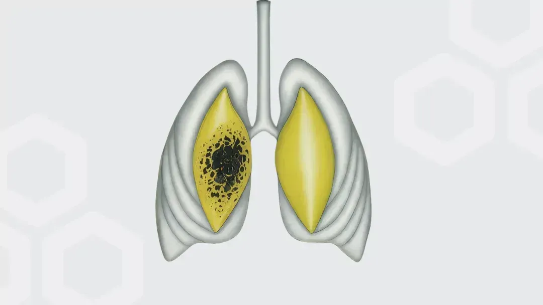 Cough Monitoring and Lung Cancer